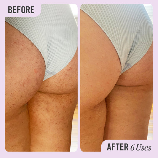 Meðferð við Keratosis Pilaris