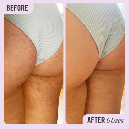 Meðferð við Keratosis Pilaris
