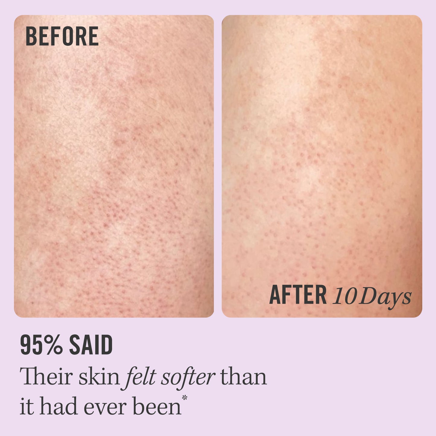Keratosis Pilaris