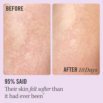 Keratosis Pilaris
