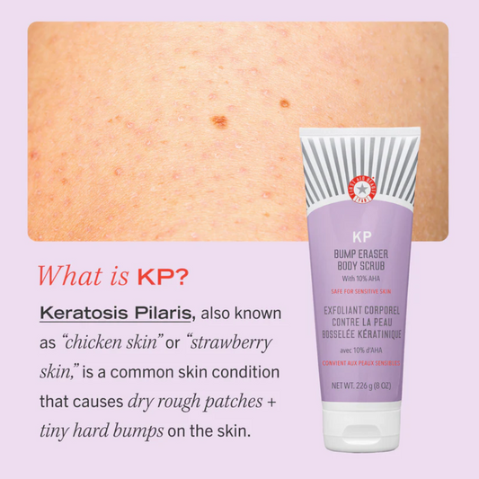 Hvað er keratosis pilaris