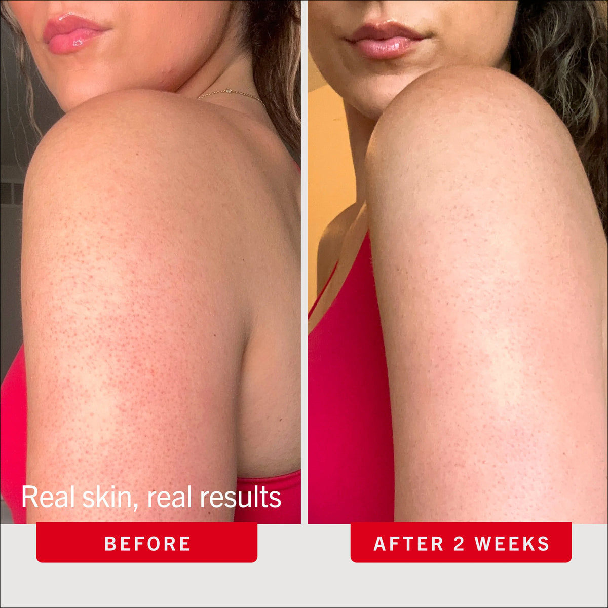 Before and after comparison of a woman's shoulder skin with text indicating results after 2 weeks.